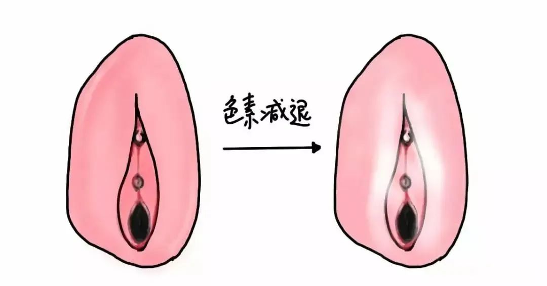 如何避免外阴白斑病情加重？