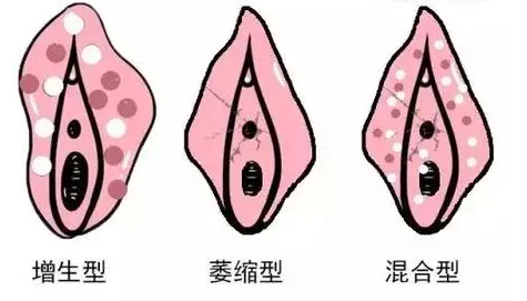 外阴白斑疾病具体有哪些类型和时期？