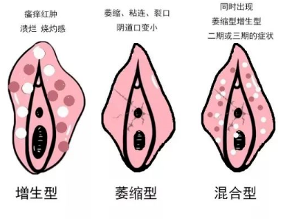 怎么区分外阴白斑和外阴湿疹？