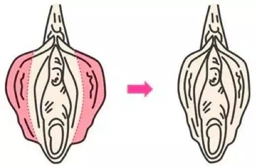 外阴瘙痒会是外阴营养不良吗？